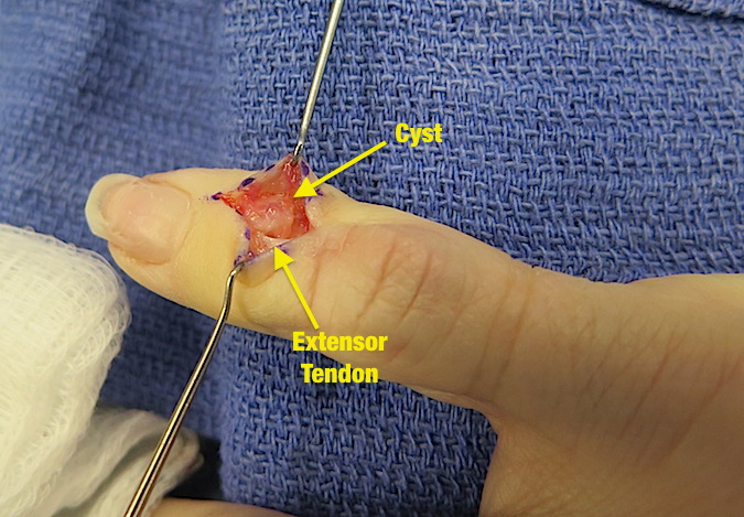 Mucous Cyst Hand Surgery Resource